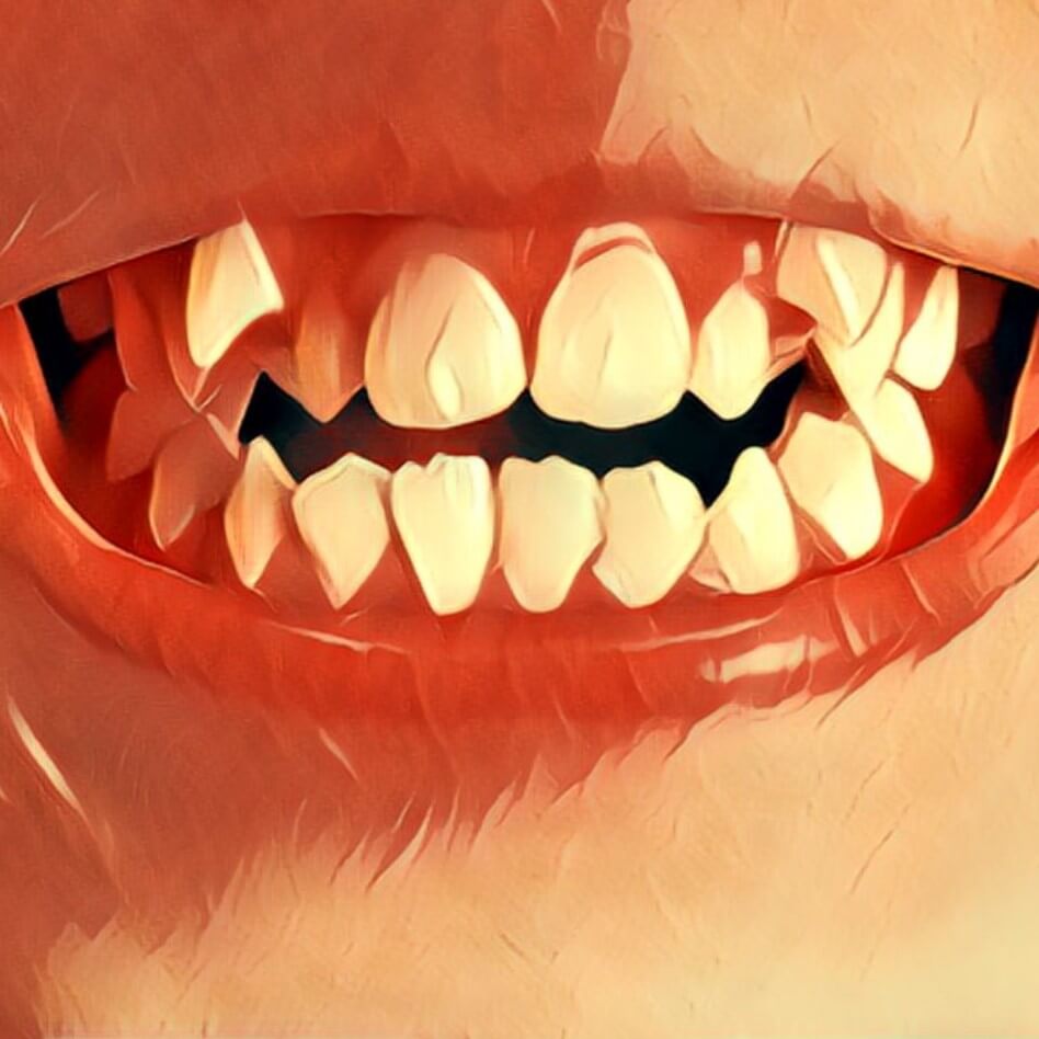 Schiefe Zähne in der Traumanalyse.